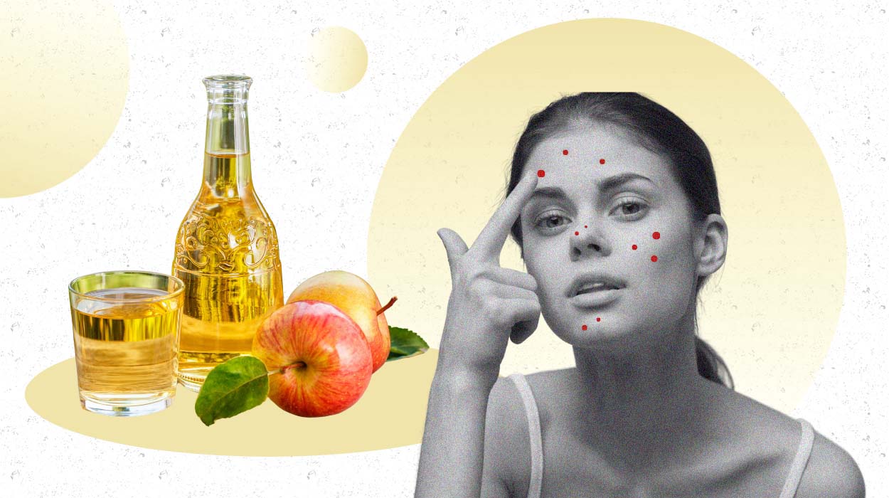 Apple Cider Vinegar For Acne